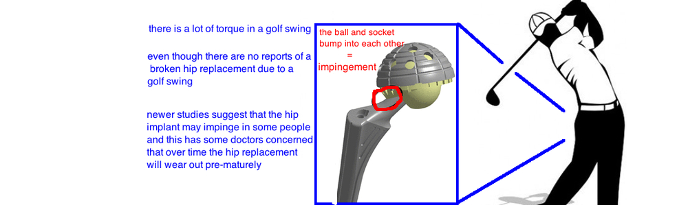 What are some highly rated hip implants?